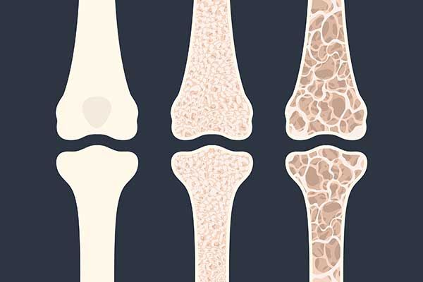 New Research Suggests Bone Loss More Likely Among Consistent PrEP Users