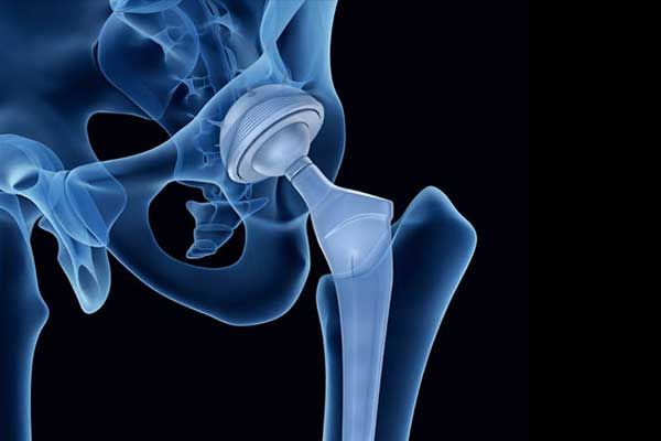 Stryker to Pay Over $1 Billion to Settle 4,000 Hip Replacement Lawsuits